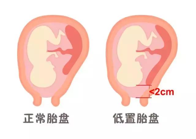 孕24周羊水偏少怎么办