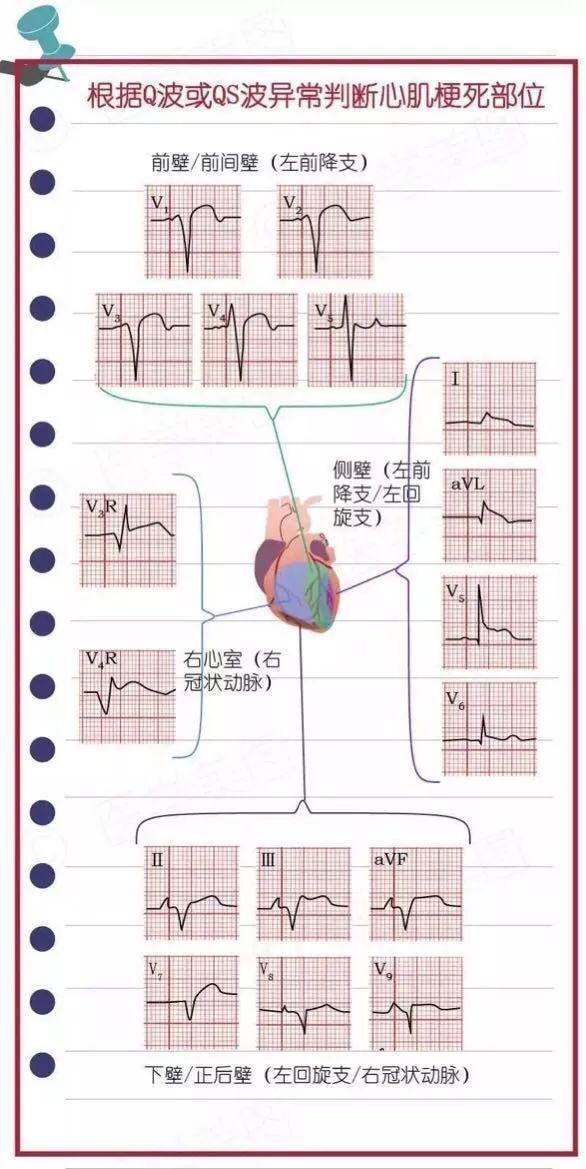 心肌梗死的心电图及临床表现