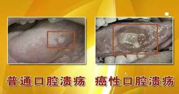 微健康口腔溃疡久了易成口腔癌你不知道的事