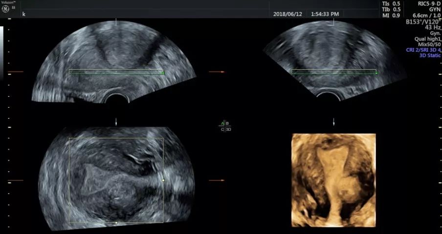 子宫肌瘤是孕龄期女性最常见的疾病之一,一般来说二维诊断即可明确