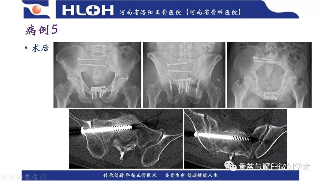 参会ppt:圆锥投影理论指导下的术前计划助力骶1骶髂螺钉导针指向调整