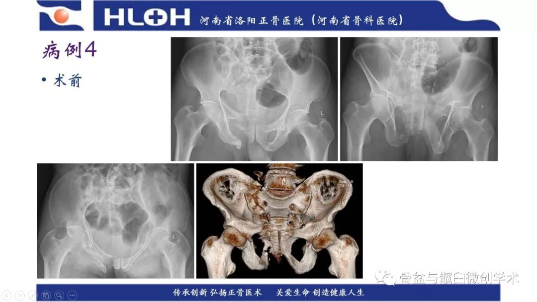 术中:插入导针,标准骶骨侧位像上确立进钉点,调整导针位于骨盆横断面