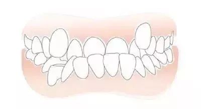 牙齿不齐有啥危害? 1,刷牙时不易清洁