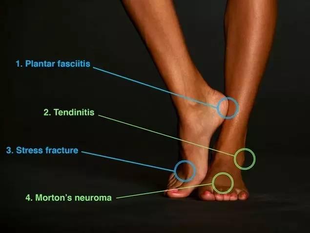 足底筋膜炎,脚踝肌腱炎,应力性骨折,莫顿神经瘤,是患病概率较大的脚部