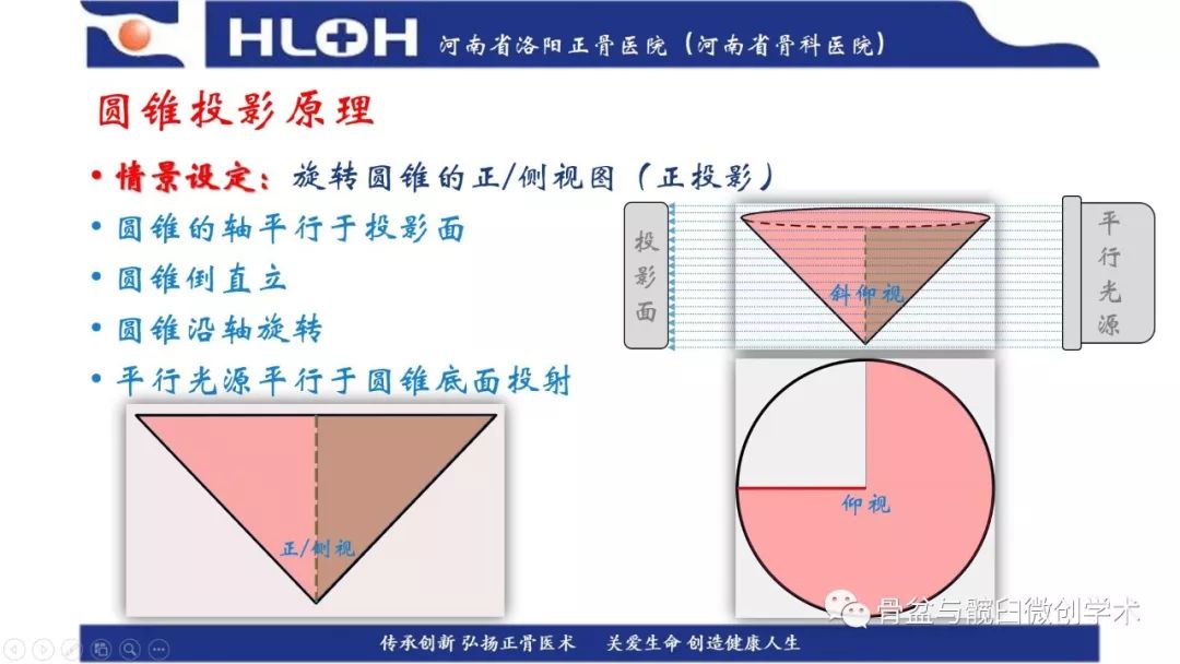 参会ppt:圆锥投影理论指导下的术前计划助力骶1骶髂