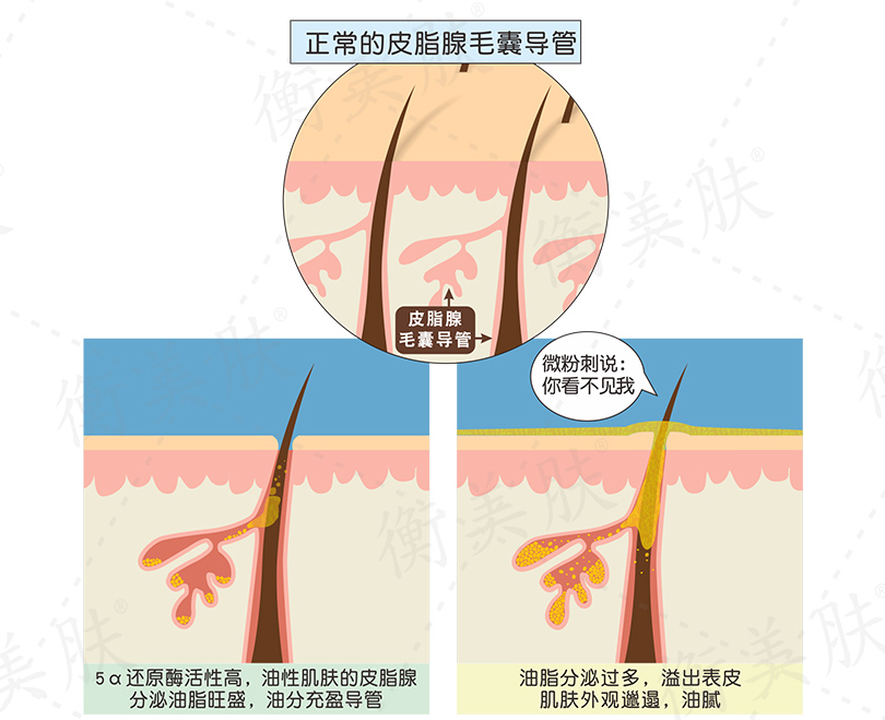 油脂分泌过多