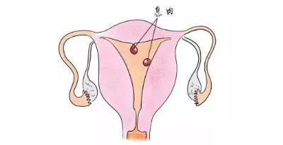 子宫内膜息肉—影响怀孕吗?