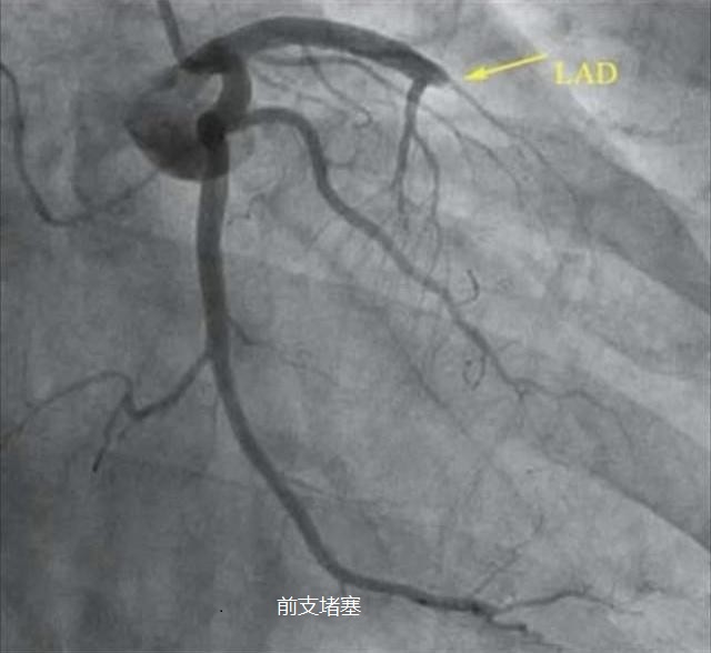 也就是堵了前降支心脏不能正常运转可能性大,堵了别的