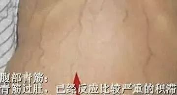 (2)如果腹部青筋比较暴突,即俗话说的"青筋过肚",这已经是比较严重的