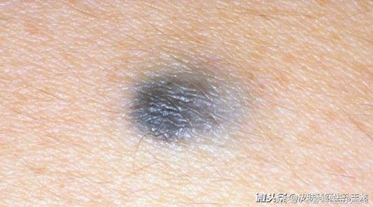 细胞蓝痣〕好发于臀部和骶尾部,损害是一个大而坚实的结节或斑块.