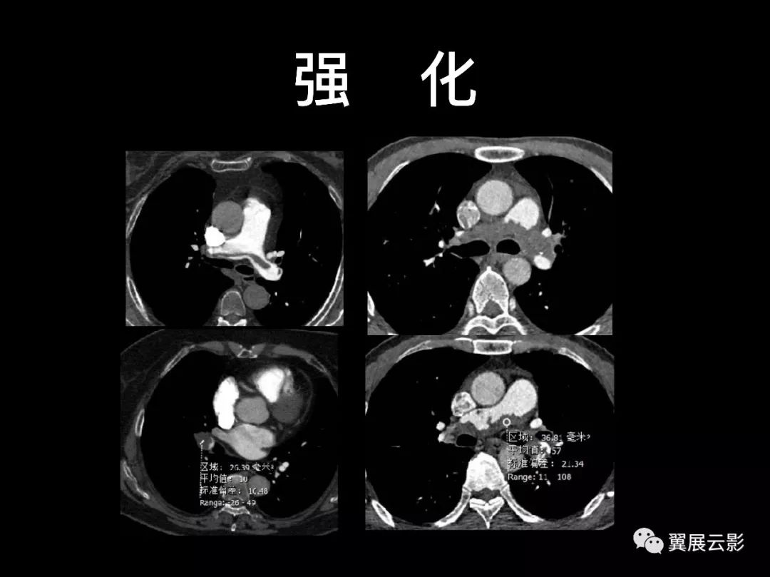 【经典回顾】肺栓塞影像诊断与鉴别