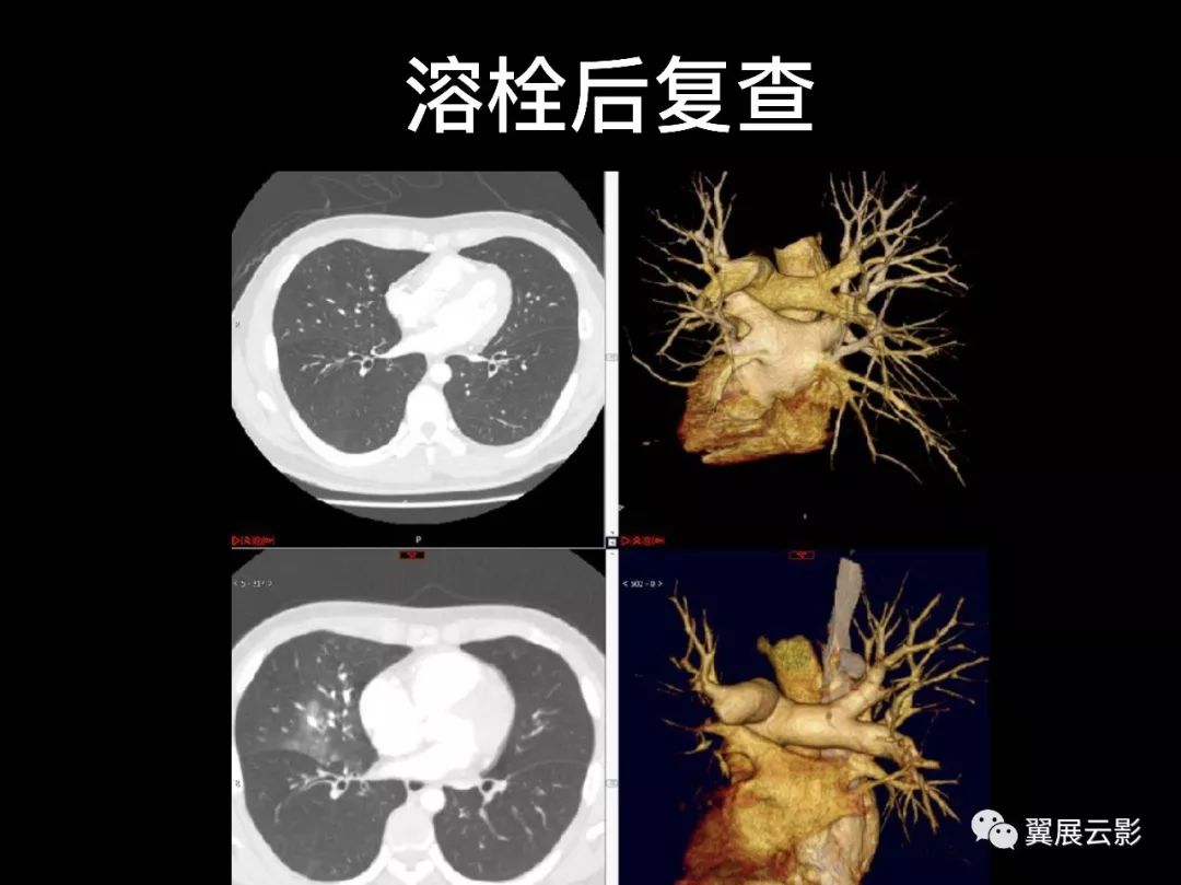 经典回顾肺栓塞影像诊断与鉴别