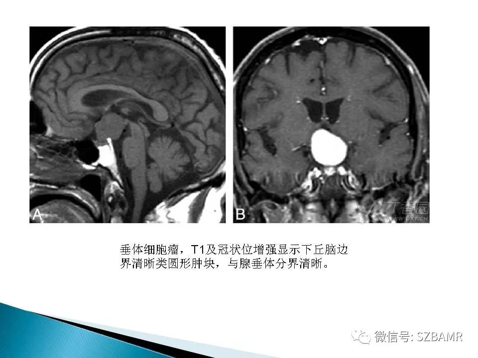 下丘脑少见肿瘤性病变的mri诊断