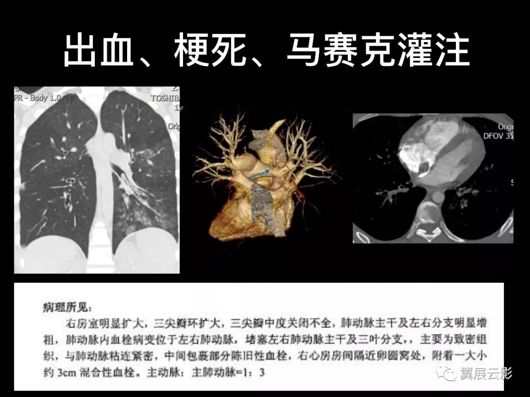 【经典回顾】肺栓塞影像诊断与鉴别