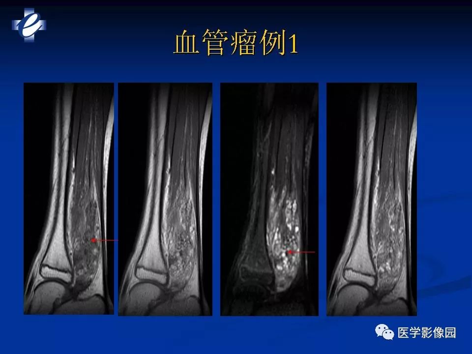 mri软组织肿瘤的影像诊断影像天地