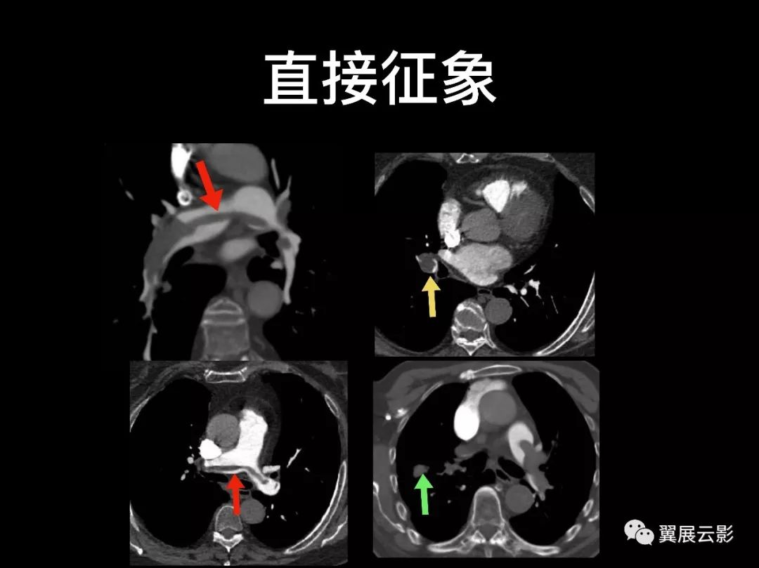 【经典回顾】肺栓塞影像诊断与鉴别