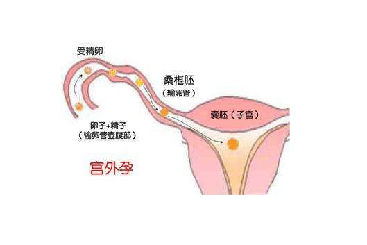 卵着床于宫腔以外的地方,例如:输卵管,卵巢,阔韧带,腹腔,子宫颈,残角