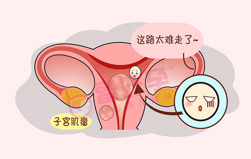 备孕期间查出子宫肌瘤,怀孕还有希望吗?