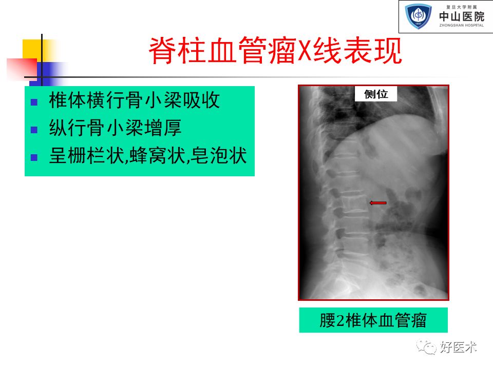 恶性肿瘤患者中约有60%发生骨转移,其中一半以上会转移至脊柱,因此