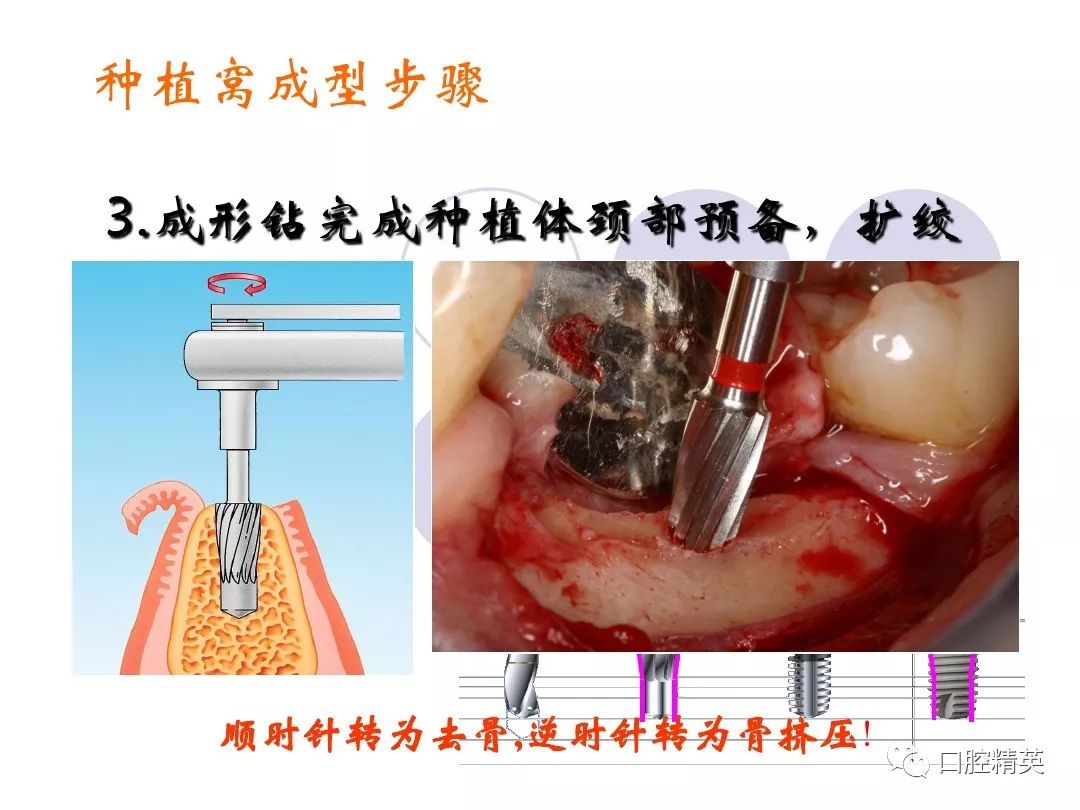 口腔科常用器械图谱,结构及功能介绍