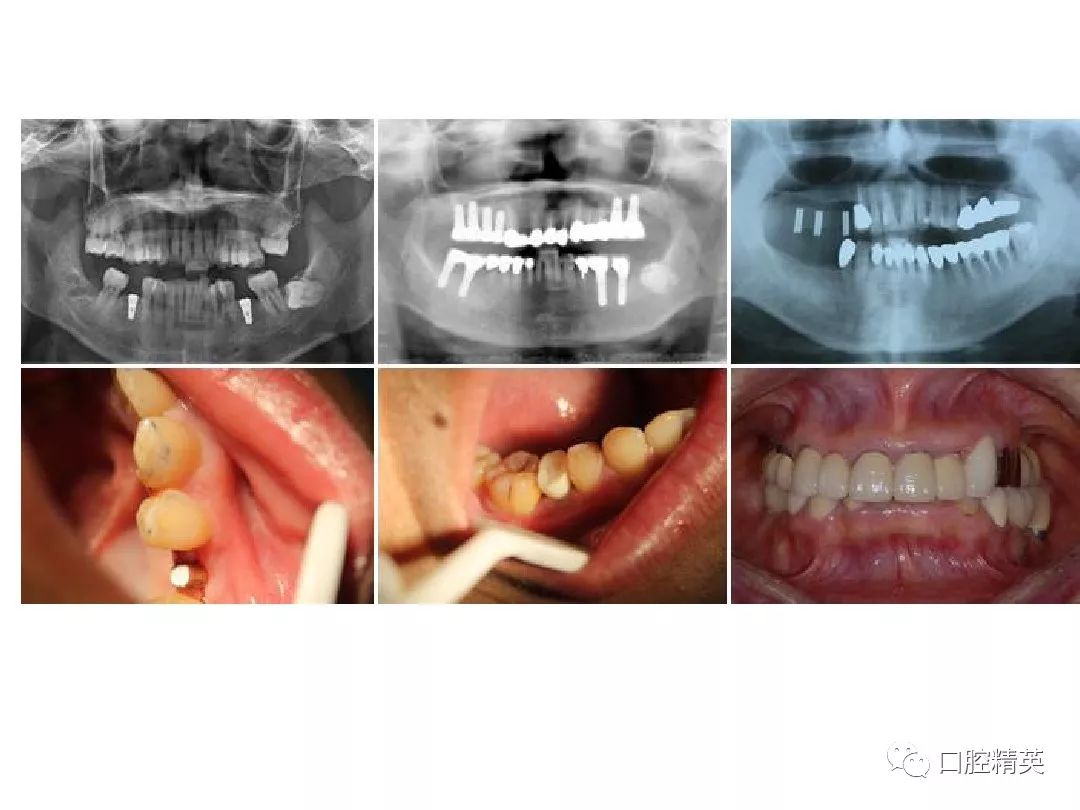 口腔科常用器械图谱,结构及功能介绍