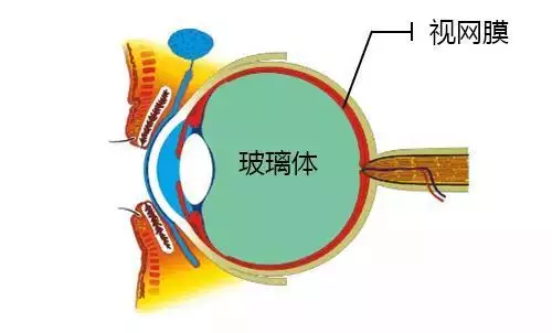 科普眼科医生手绘图为您详解飞蚊症