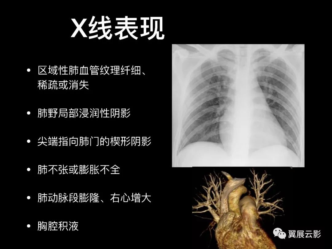 【经典回顾】肺栓塞影像诊断与鉴别