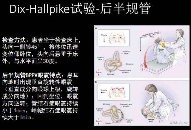 性眩晕的手法治疗1,epley手法-后半规管bppv后半规管复位三维动画▼2