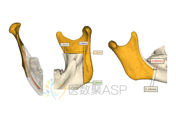 右侧升支模拟截骨左侧升支模拟截骨,去干涉【产品规划】中间咬合板