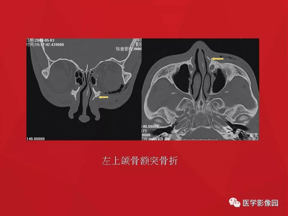 鼻骨骨折影像学诊断与鉴别 影像天地