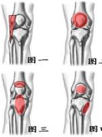 我们先来看一下膝关节不同部位的疼痛.