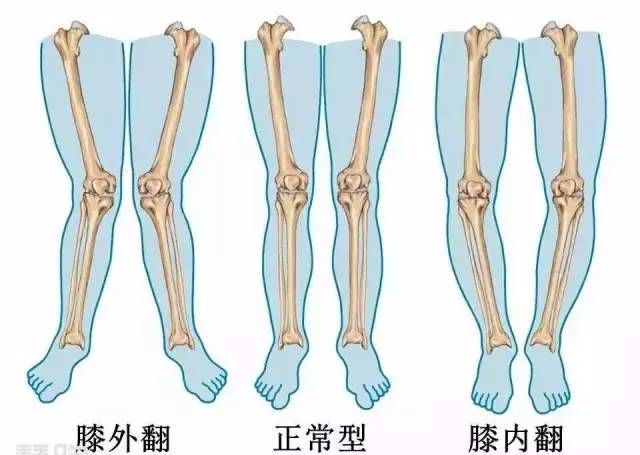 x型腿如何矫正