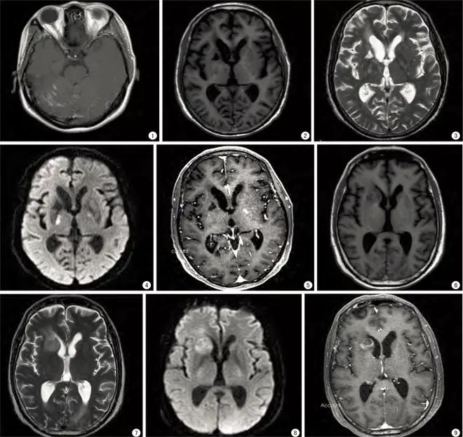 mri示双侧基底节区多发椭圆形胶性假囊和血管周围间隙增宽(v-r),图2示