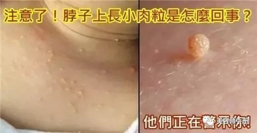 脖子上长小肉粒?千万要当心!