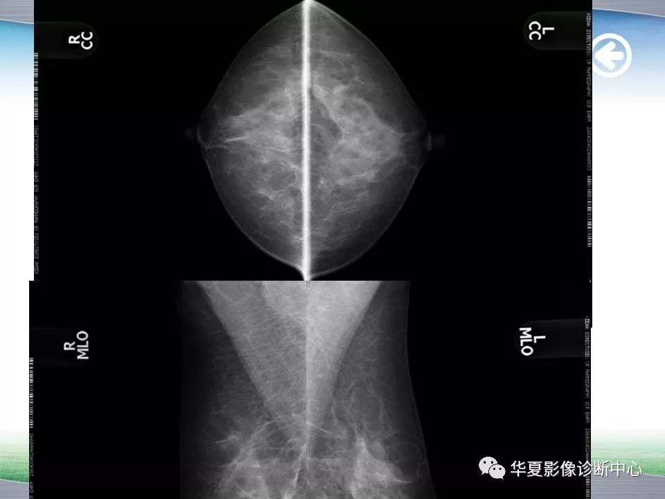 乳腺x线技术与诊断包括检查方法乳癌筛查指南birads报告系统常见病x