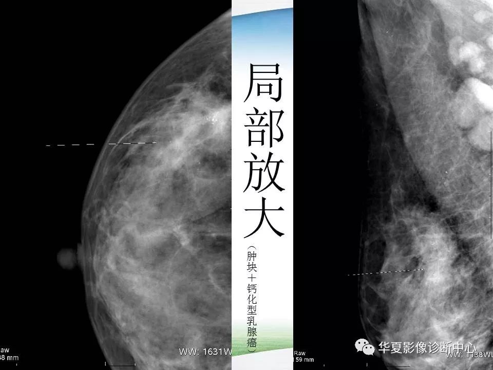 乳腺x线技术与诊断包括检查方法乳癌筛查指南birads报告系统常见病x