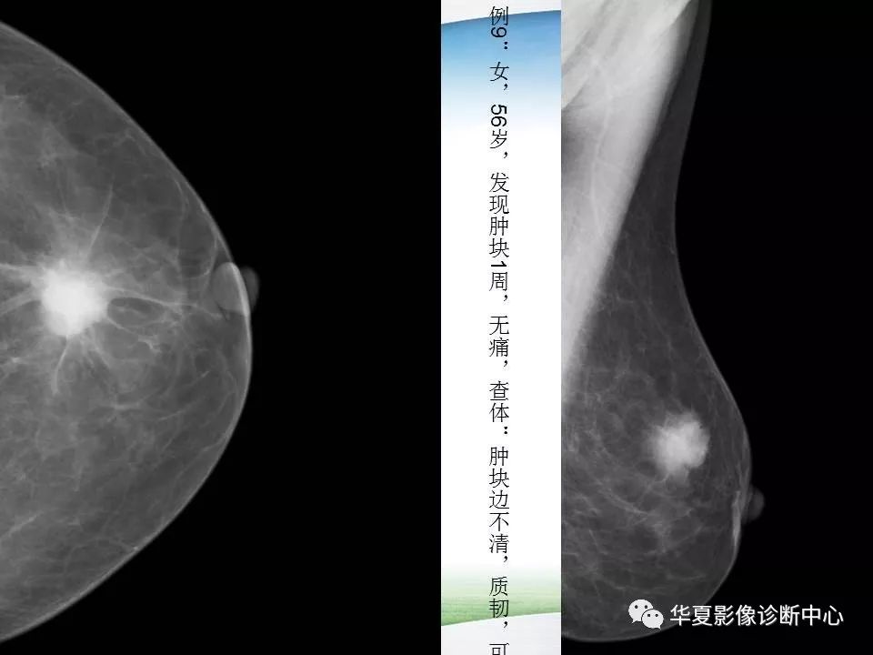 乳腺x线技术与诊断包括检查方法乳癌筛查指南birads报告系统常见病x