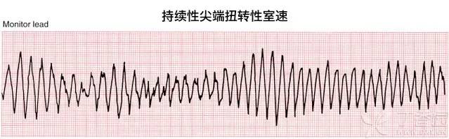 房速室速室上速,辨别秘籍在这里