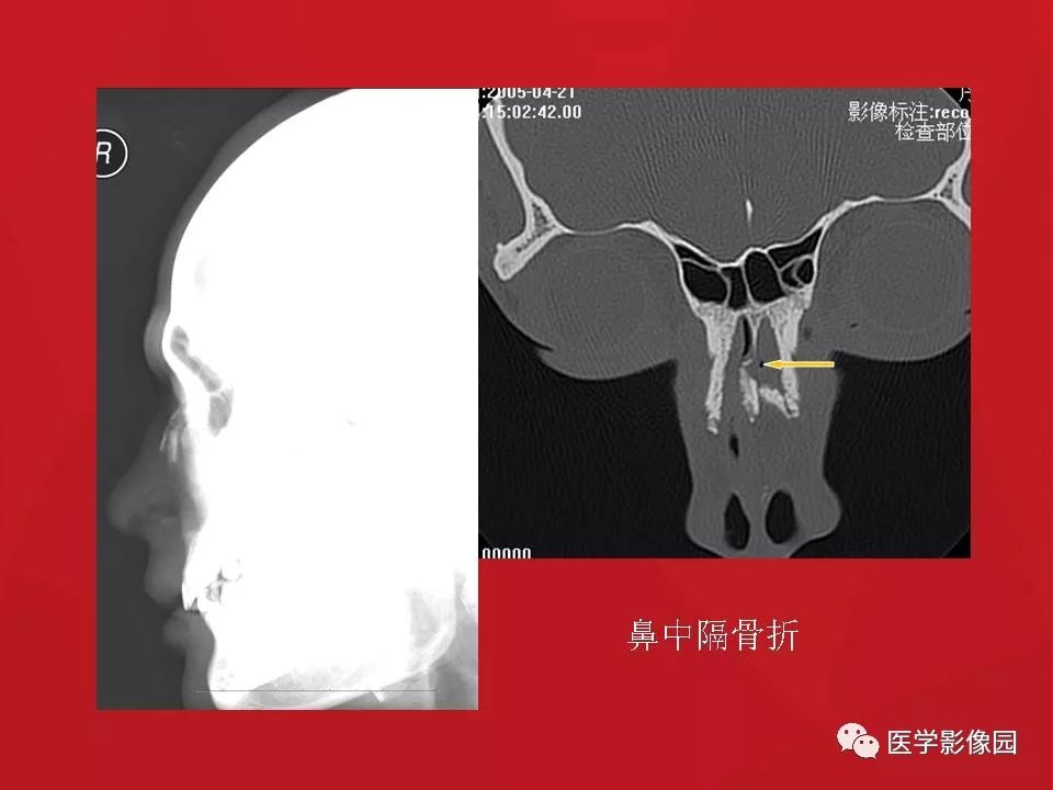 鼻骨骨折影像学诊断与鉴别