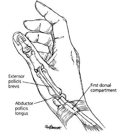 tenosynovitis),或叫 dequervain"s syndrome,症状是在手腕大拇指侧