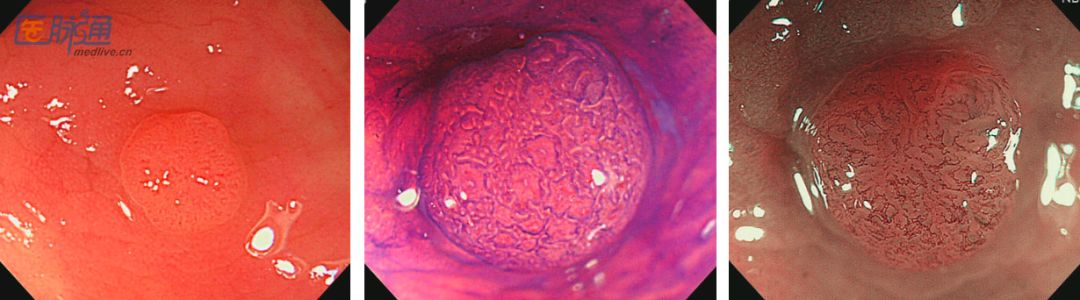 大多数结肠腺瘤为管状腺瘤(tubular adenoma),散在生长.