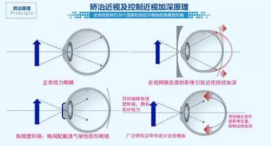 8岁近视300度怎么办