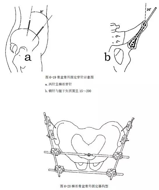 【基层中医适宜技术】骨伤类—骨外固定支架技术(下)