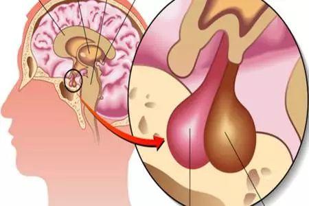 视力下降?或是垂体瘤惹的祸,神外微创解疾患