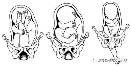 对于头位胎宝宝来说,因为头部是全身最大且最硬的部分,灰凡磕芡ü