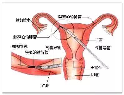 输卵管介入治疗是如何做的