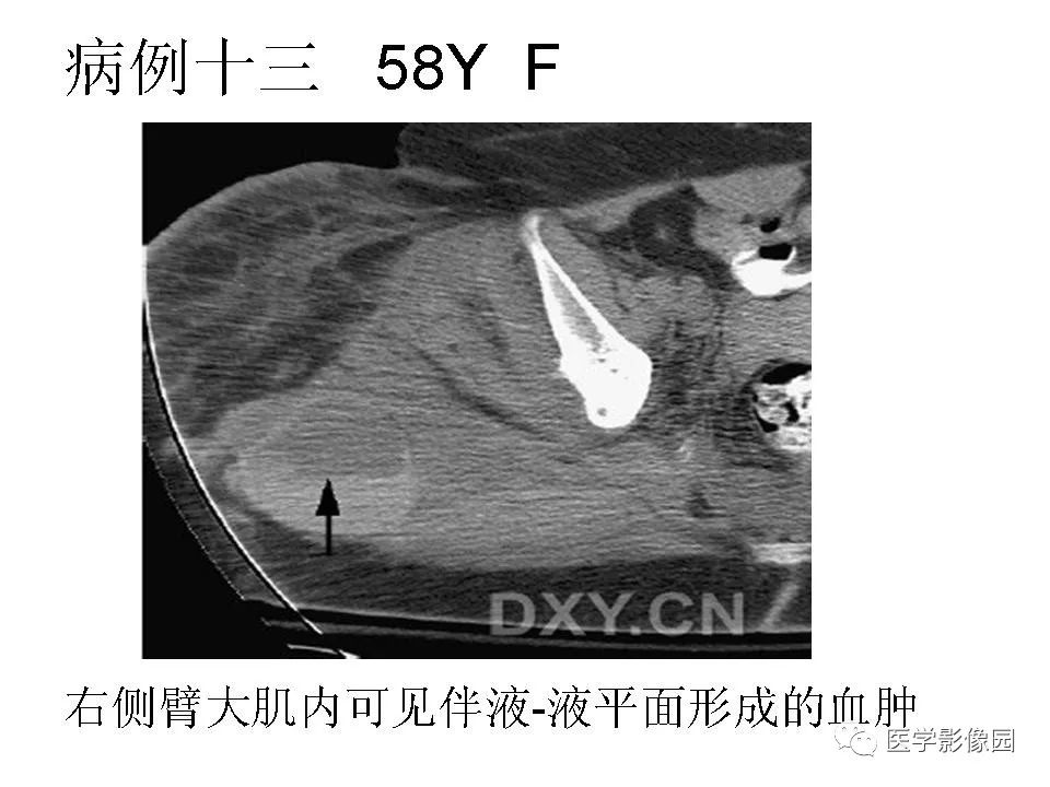 出现液液平面的肌骨系统病变影像天地