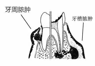 牙龈长了牙齿怎么办