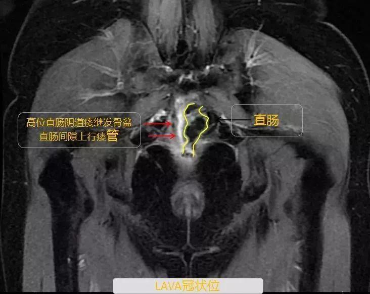 直肠癌术后;直肠吻合口瘘;中上段直肠重度管状狭窄;高位直肠阴道瘘