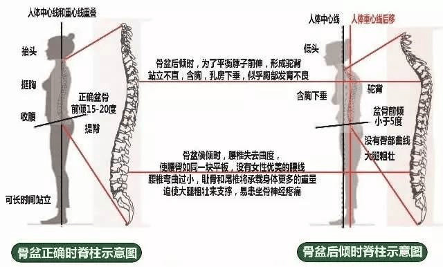 注意!你的骨盆歪